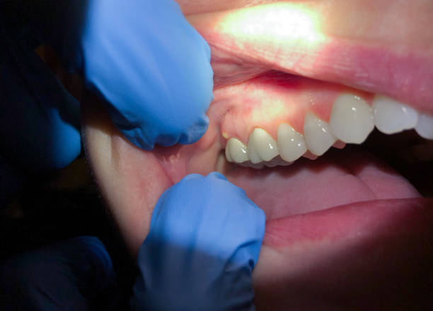 Best Emergency Dentist for Knocked-Out Tooth in Wright City, MO