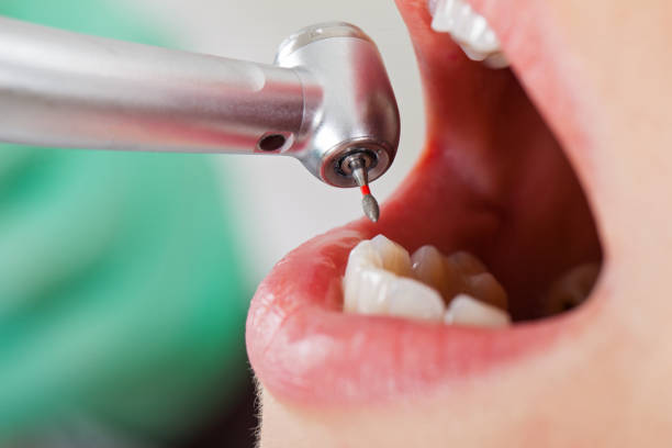 Best Emergency Root Canal Treatment in Wright City, MO